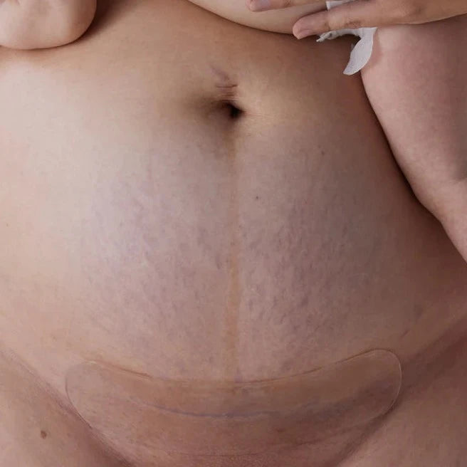 Close-up of a pregnant belly with stretch marks, partially covered by hands and a transparent belly band, treated with Bare Mum Silicone Gel Scar Strips by Bare Mum.